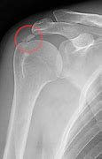 Image result for Rotator Cuff U-shaped Clip