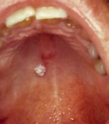 Image result for Verruca Vulgaris Mouth