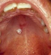 Image result for Verruca Vulgaris Lip