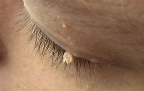 Image result for Malignant Papilloma