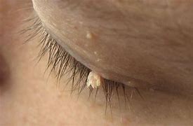 Image result for Papilloma