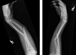 Image result for Broken Arm Both Bones
