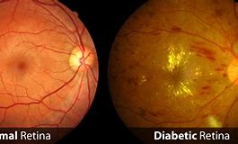 Image result for Diabetic Retinopathy