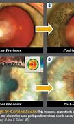 Image result for Lasik Corneal Scar