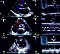 Image result for Normal Echocardiogram Image View