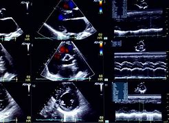 Image result for cardiogrwf�a