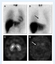 Image result for SPECT Case