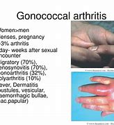 Image result for Gonorrhea Arthritis