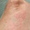 Image result for Pediatric Hives