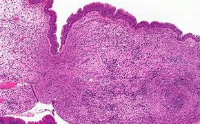 Image result for Sinonasal Inflammatory Polyp