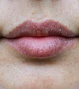 Image result for What Causes Dry Chapped Lips