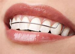 Image result for Retainer for Overbite