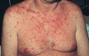 Image result for HIV Lesions On Skin