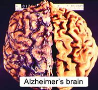 Image result for Brain with Alzheimer's
