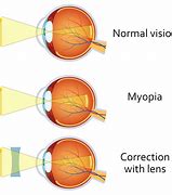 Image result for Corrective Lenses for Myopia