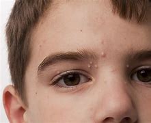 Image result for Water Warts Molluscum Contagiosum