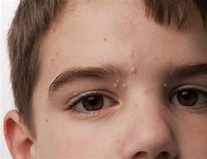 Image result for Molluscum Contagiosum Back Acne