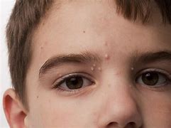 Image result for Molluscam Contagiosum Virus