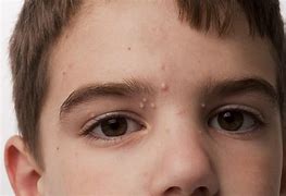 Image result for Molluscum Contagiosum On Stomach