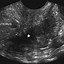 Image result for Endometrial Cyst Sac
