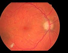 Image result for Cotton-Wool Spots Retina