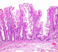Image result for Sessile Polyp Cecum