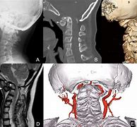 Image result for Rachischisis of Spinal Cord