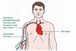 Image result for PICC Line Antibiotics