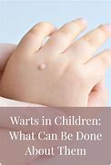 Image result for Water Warts Asian Child