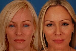 Image result for Before and After Botox Face