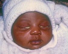 Image result for Gonorrhoea Babies