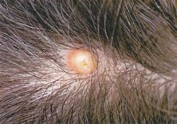 Image result for Hard Cyst On Scalp