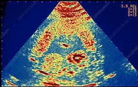 Image result for Anencephaly Diagram