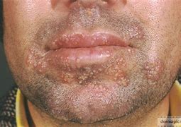 Image result for herpes
