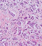 Image result for Lung Carcinoid Tumor