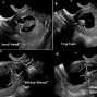 Image result for Frog Sign Anencephaly