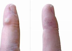 Image result for Wart Removal Before and After