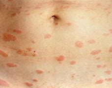 Image result for Red Rash Spots On Skin