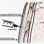 Image result for Chest Tube Positioning