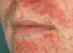 Image result for Rash around the Mouth in Adults