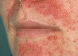 Image result for Rash On Face around Mouth and Nose