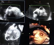 Image result for Anencephaly Radiology