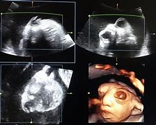 Image result for Anencephaly Ultrasound Images