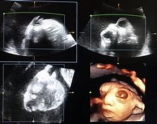 Image result for Anencephaly Images