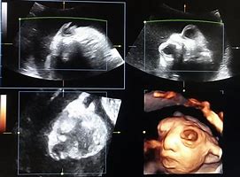 Image result for Anencephaly Ultrasound Diagnosis