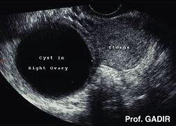 Image result for 6 Cm Ovarian Cyst