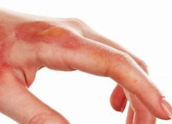 Image result for Chemical Burns On Hands