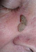 Image result for Human Papillomavirus Face