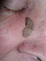 Image result for Squamous Papilloma Pathology