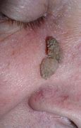 Image result for Papilloma On Soft Palate